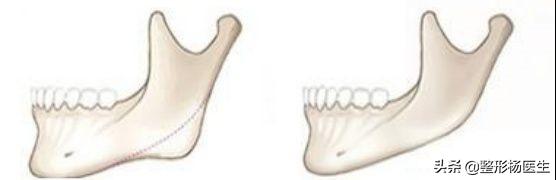 削骨后遗症最严重的后果,削骨失败案例后遗症