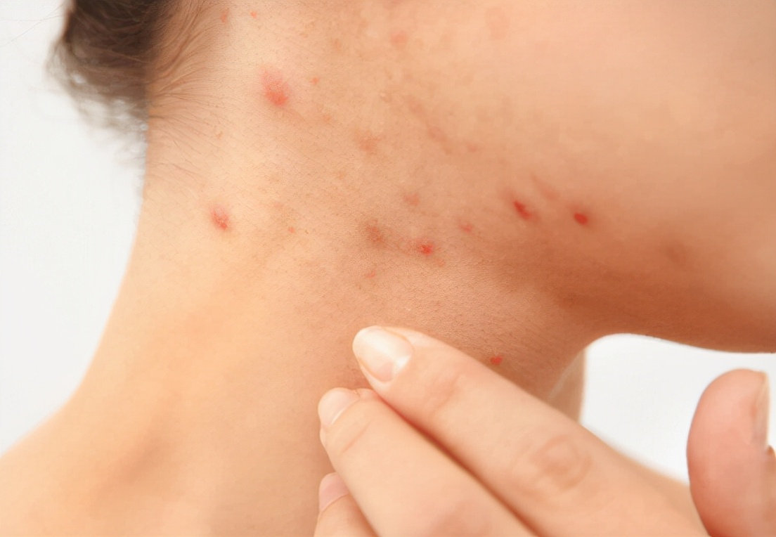 阿奇霉素治疗风险,阿奇霉素是抗菌类药物吗