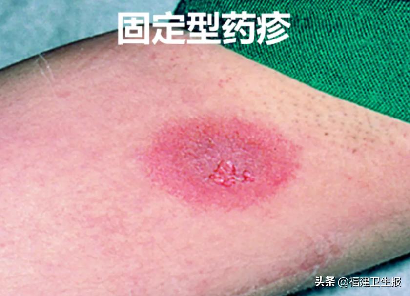 阳了后浑身痒、起疹子？医生提醒：分清类型再治疗