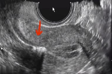 试管胚胎移植需要憋尿吗,试管婴儿胚胎移植需要憋尿多久