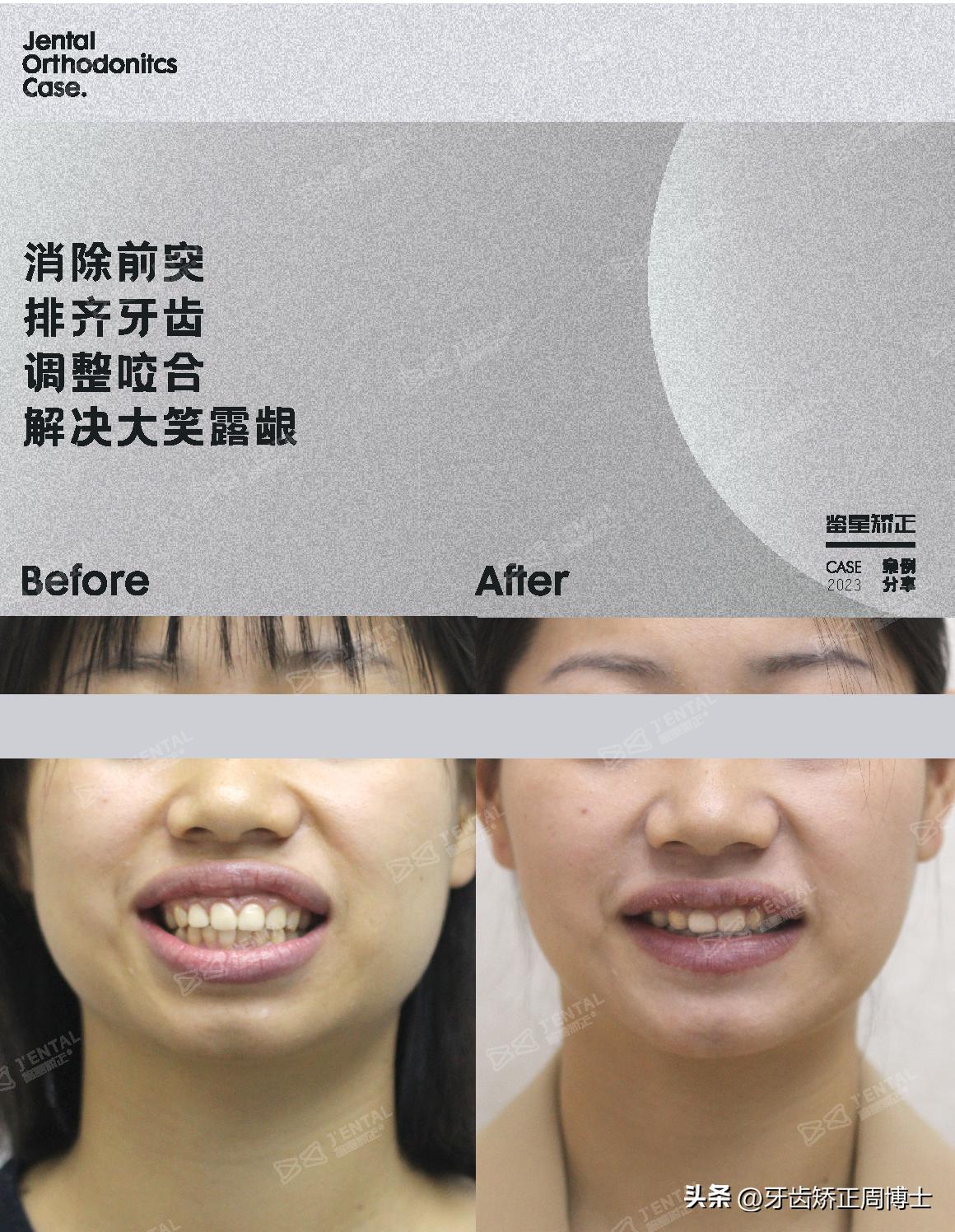 骨性上颌前凸嘴怎么矫正,厚嘴唇与嘴凸有关吗