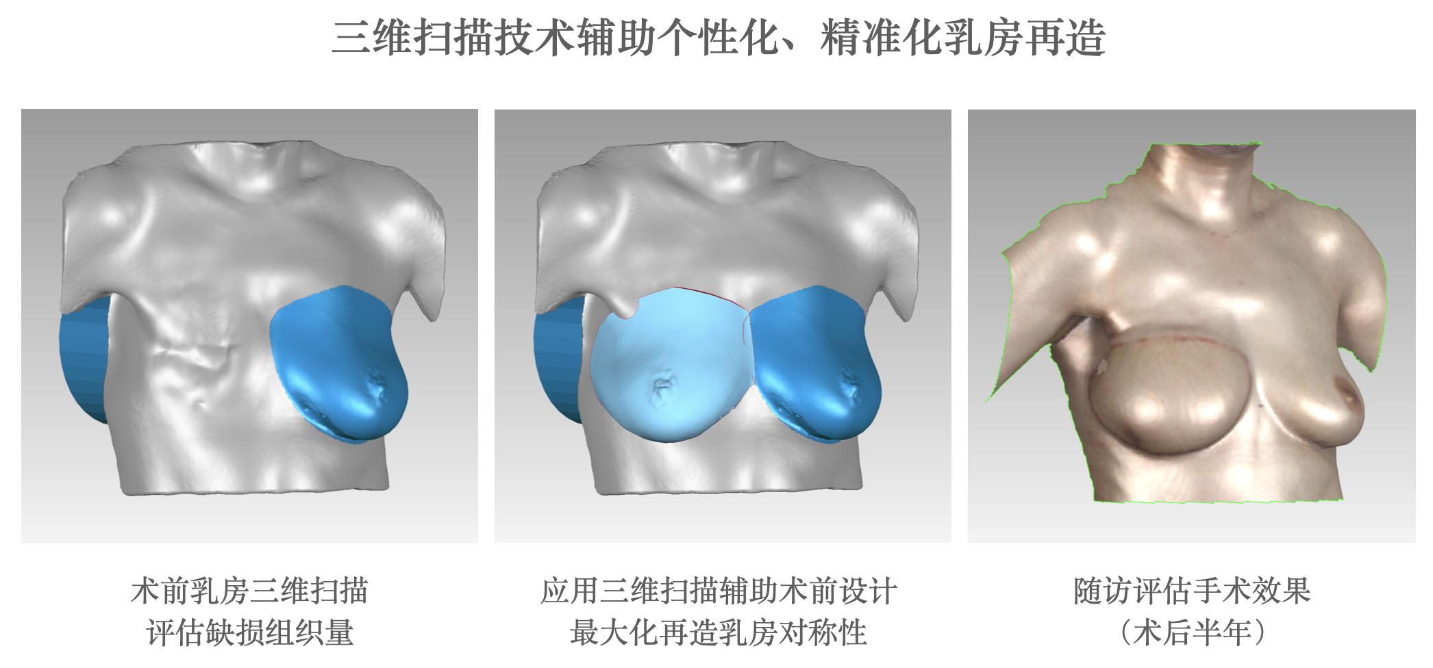 乳腺癌一期假体再造术,乳腺重建与乳房再造
