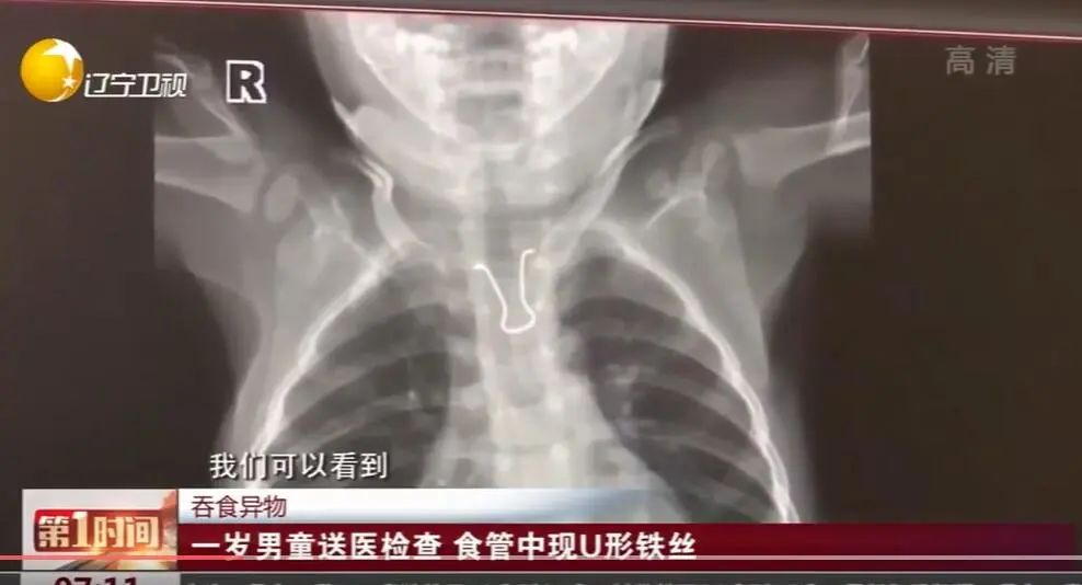 11个月大婴儿,吞下一枚3cm钉子!家长平时一定要收好家中小物品