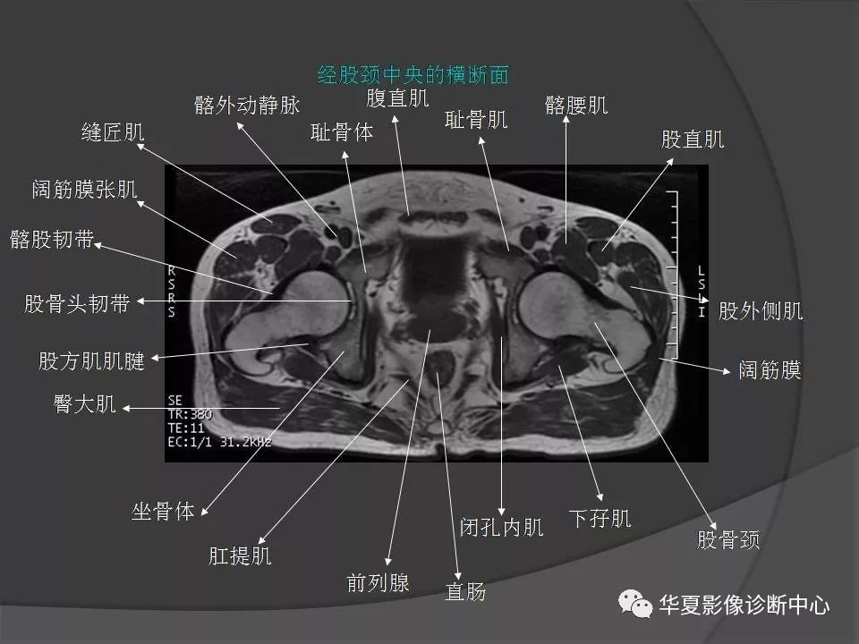 女性盆腔ct连续断层解剖图,盆腔mri影像病例分析