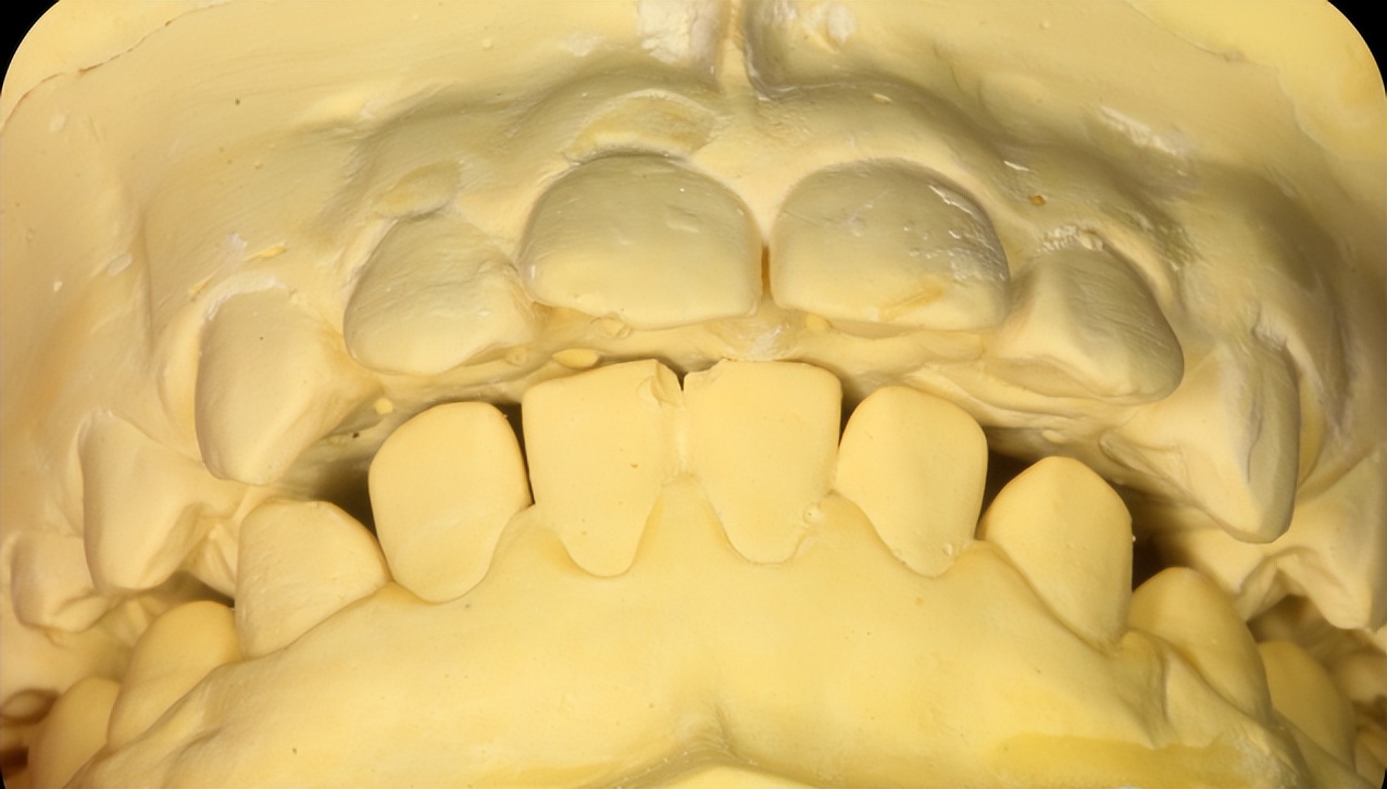 成人深覆合有必要矫正吗,深覆合矫正到一半后悔了