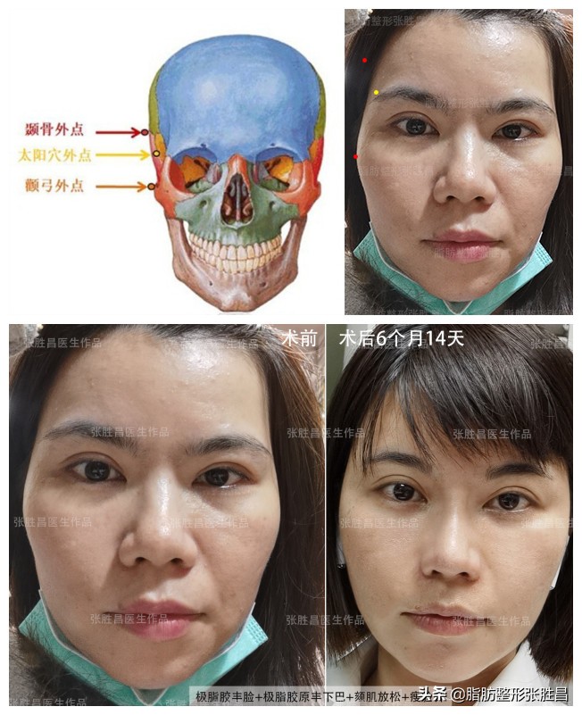 自体脂肪隆胸填充过来人的感受,千万别盲目减肥亲身经历