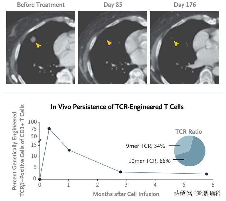 胰腺癌免疫治疗效果好吗,胰腺癌免疫靶向治疗