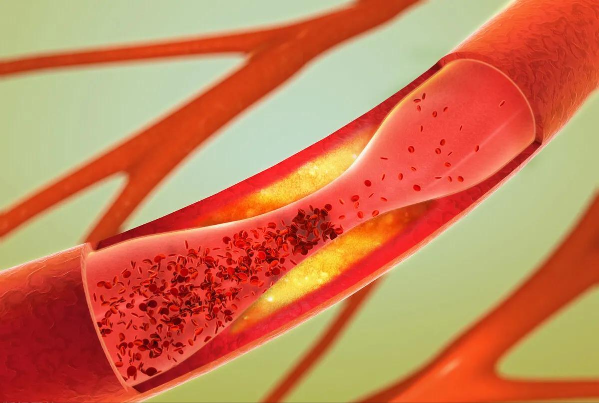 动脉粥样硬化要吃降血脂药吗,动脉粥样硬化吃降血脂的药有用吗