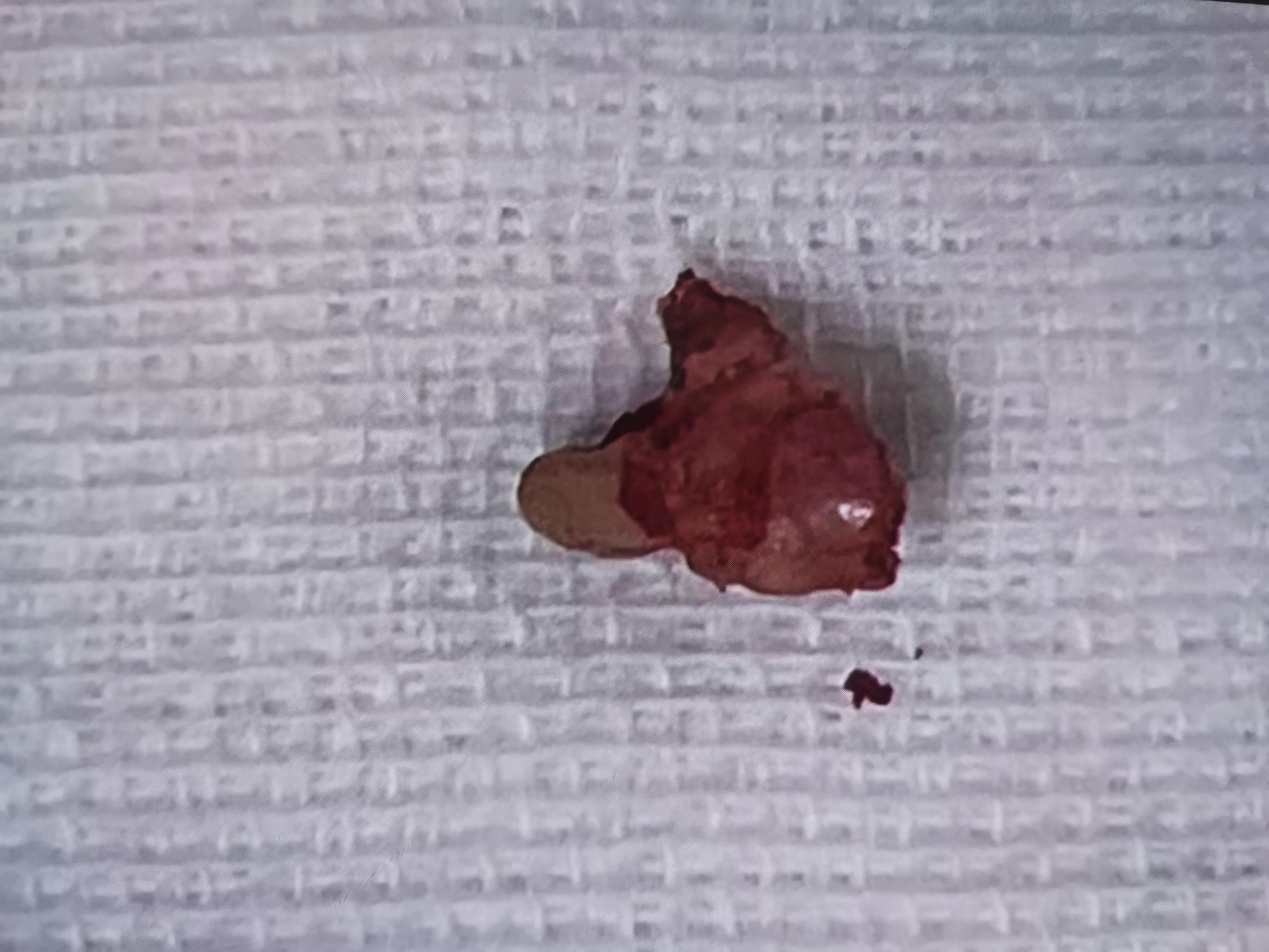 拔牙后第四天伤口能完全愈合了吗,拔牙后可以用口腔呼吸