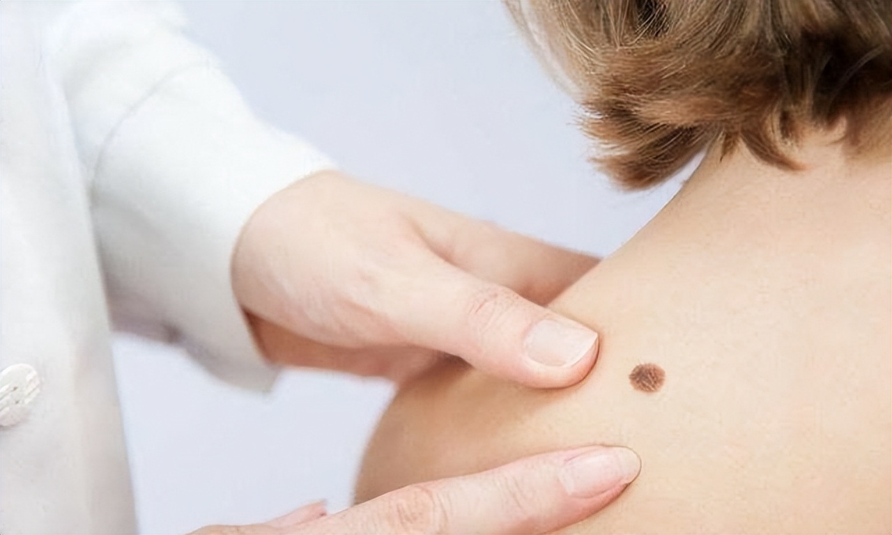 黑痣上长毛是好痣还是坏痣,脸上有个凸出的黑痣是好痣吗