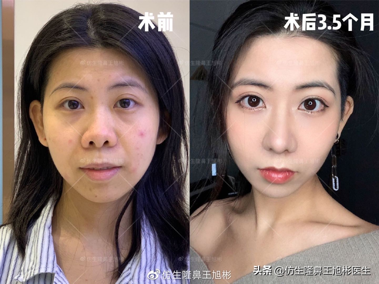 常见鼻部整形美容项目,整形鼻和自然鼻