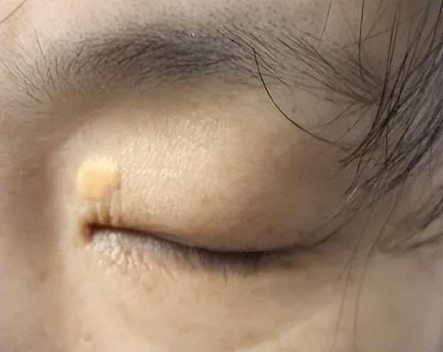 眼睛周围总感觉有飞虫是怎么回事,眼睛周围有飞虫的感觉