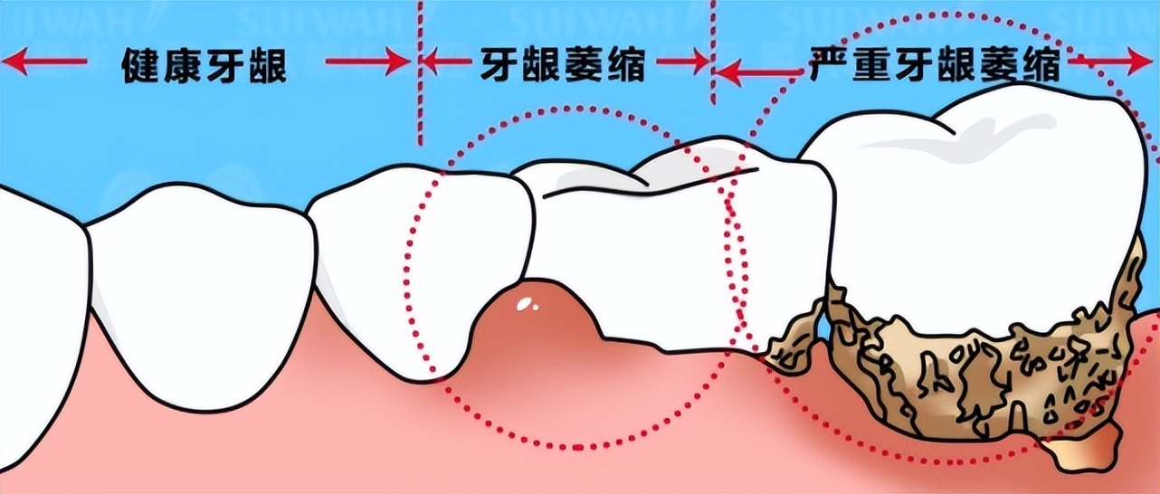 30多岁吃东西就塞牙牙疼怎么办,50岁经常牙疼是建议拔牙吗