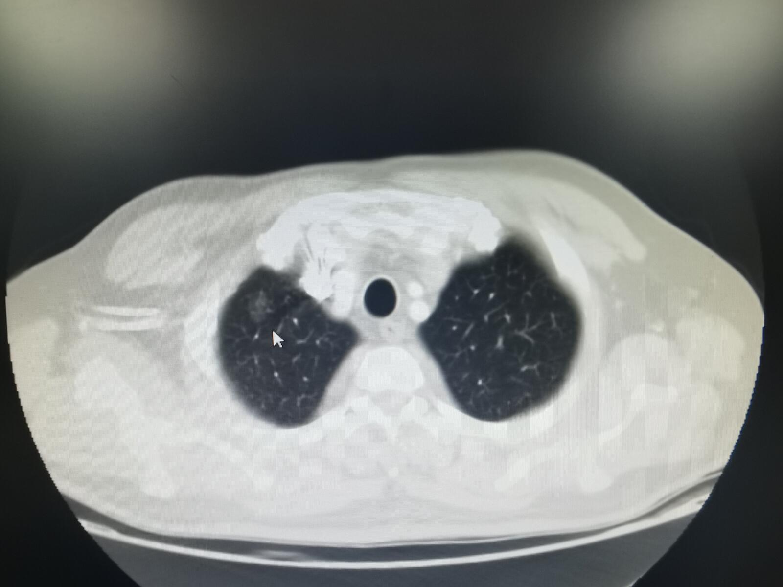 刘懿博士说肺癌化疗,刘懿博士说肺癌的书