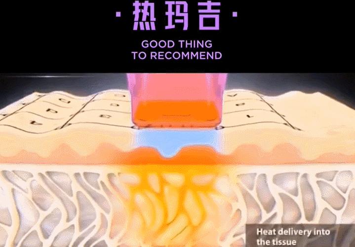 1条颈纹=显老10岁，可怕的颈纹还有救吗？