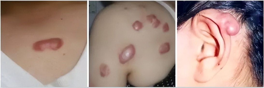 疤痕体质人群应如何预防,怎样才能治疤痕体质