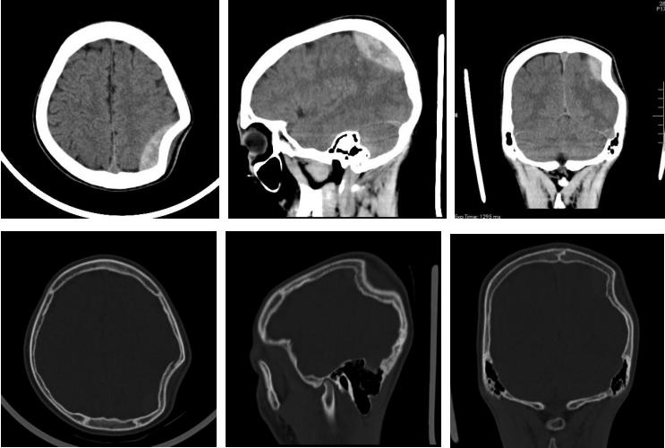 飞来横祸，初中生脑袋被铅球砸出一个“坑”