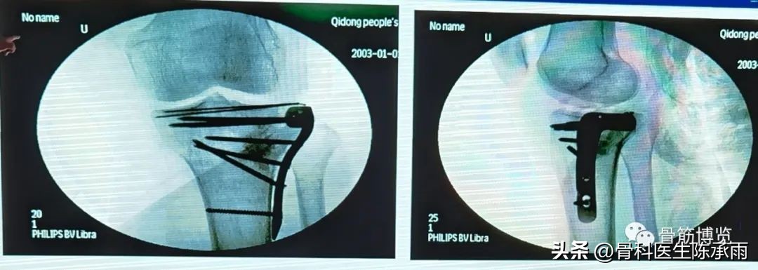 国家卫健委主办的骨创伤专项能力培训项目----下肢损伤学习班