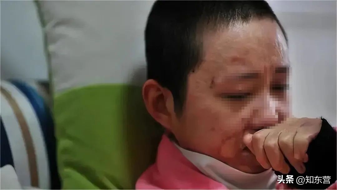 遭男友泼汽油烧伤的女孩现状,被富二代泼油毁容的女孩