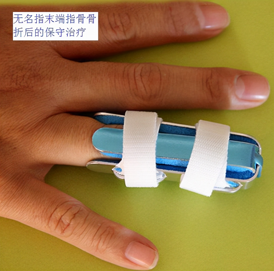 手掌骨折保守治疗和手术的优劣,手指骨折是手术还是保守治疗