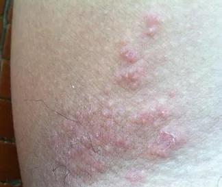 参椒汤能治好湿疹吗,我得了慢性湿疹怎么治