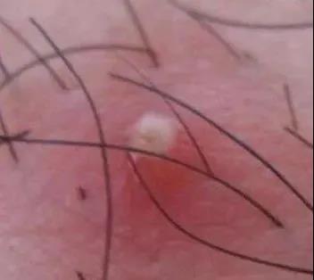 鍙戦檯绾块暱浜嗕笜鐤圭棙,鍙戦檯绾块暱鐥樻槸闈掓槬鐥樺悧