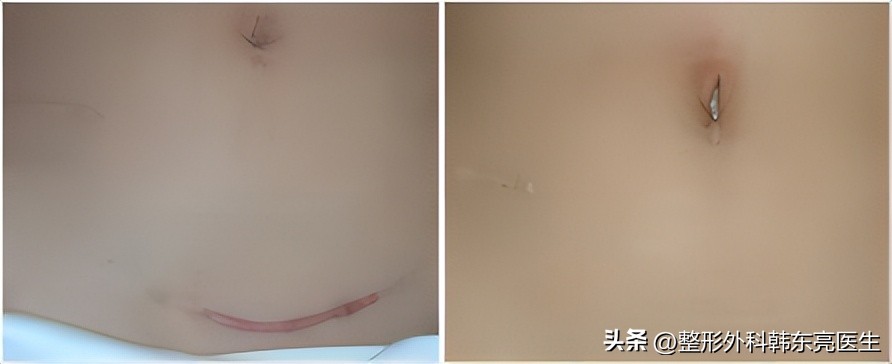 脸部疤痕最好的修复方法,修复凹陷疤痕的最好方法