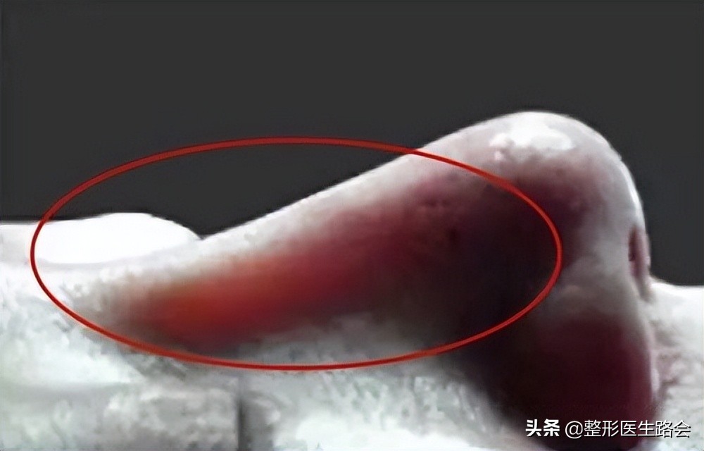 硅胶隆鼻和耳软骨隆鼻效果图,硅胶耳软骨隆鼻副作用