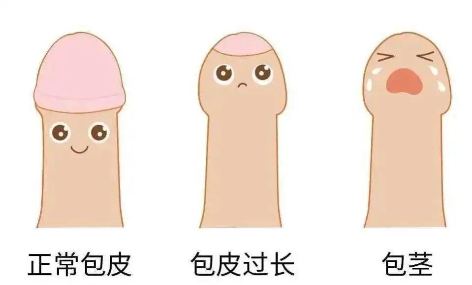 关于包皮手术的说法,关于包皮过长的问题