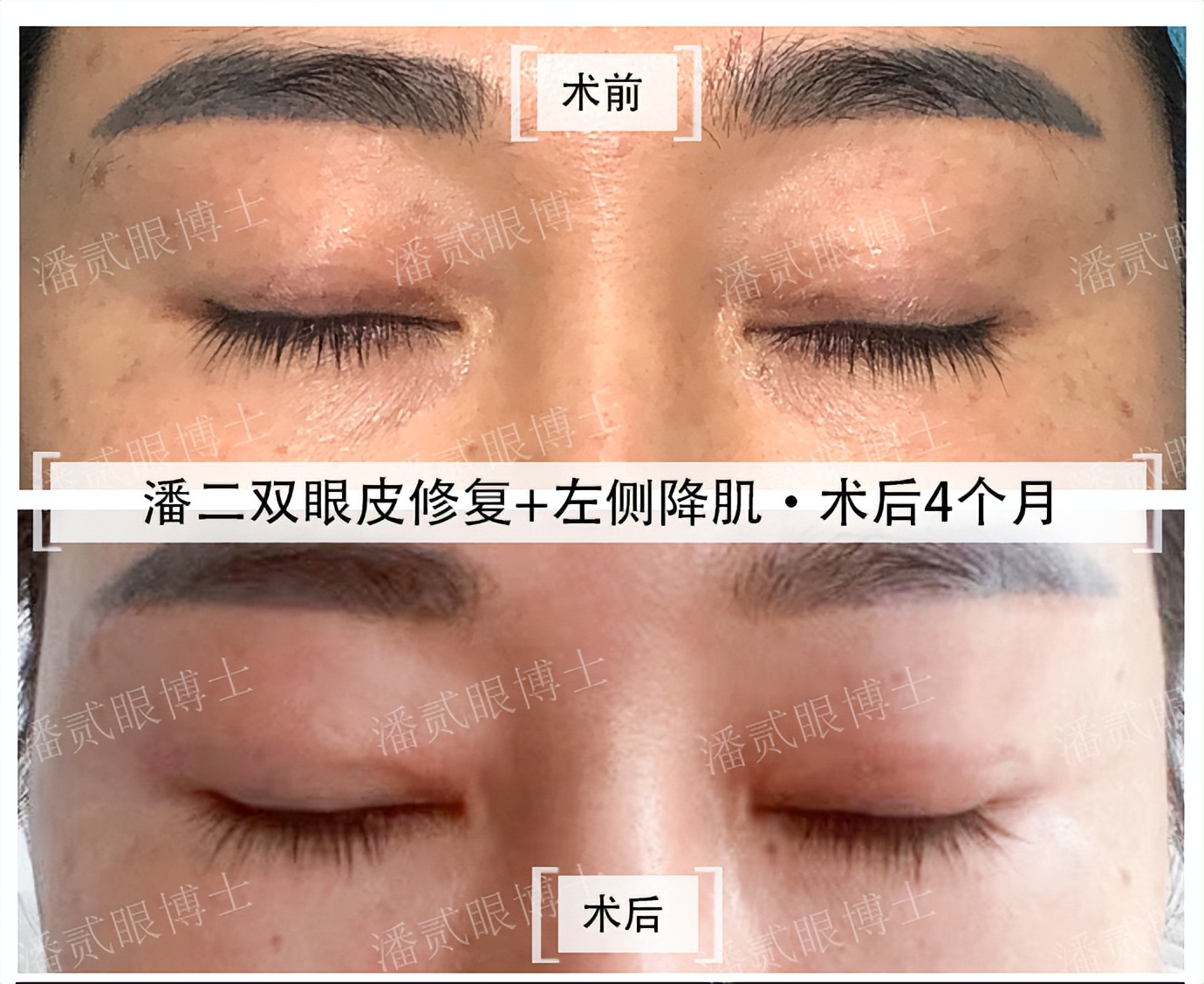 眼部提肌手术副作用,眼部提肌术可以不割双眼皮吗