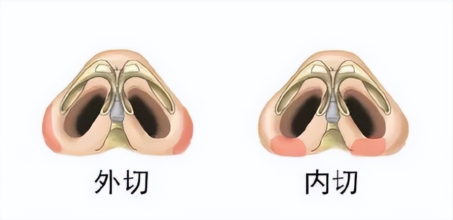 不对称鼻子矫正方法,如何使自己的鼻子变好看