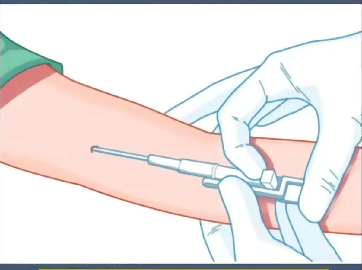 植入式避孕棒的优缺点,有哪些避孕措施与优缺点