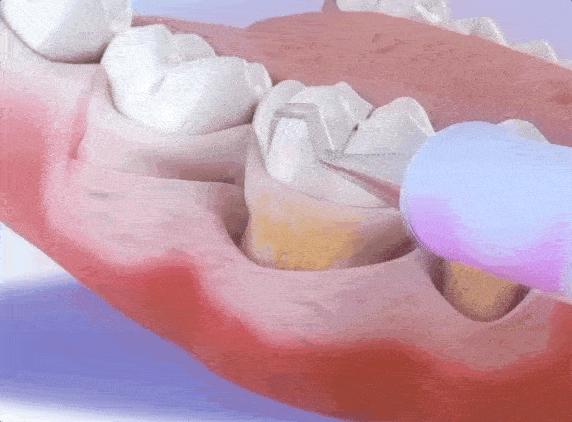 牙龈出血牙齿松动最佳补救方法,牙龈出血牙齿松动怎么办