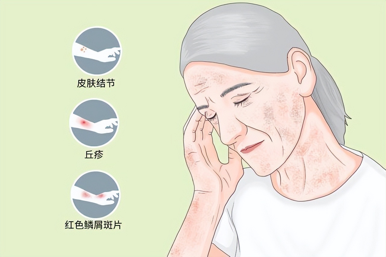 女子鼻子里长瘤,女子鼻子长疙瘩以为黑头竟是癌症