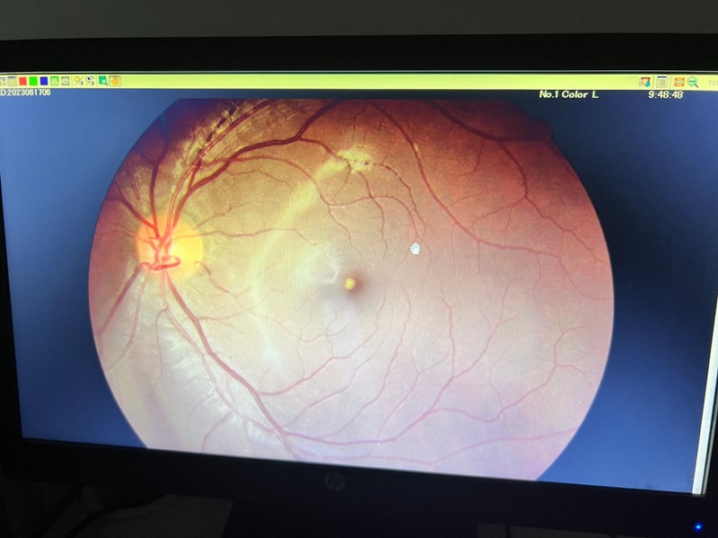 激光视力矫正危害,警惕激光笔对眼睛的损伤