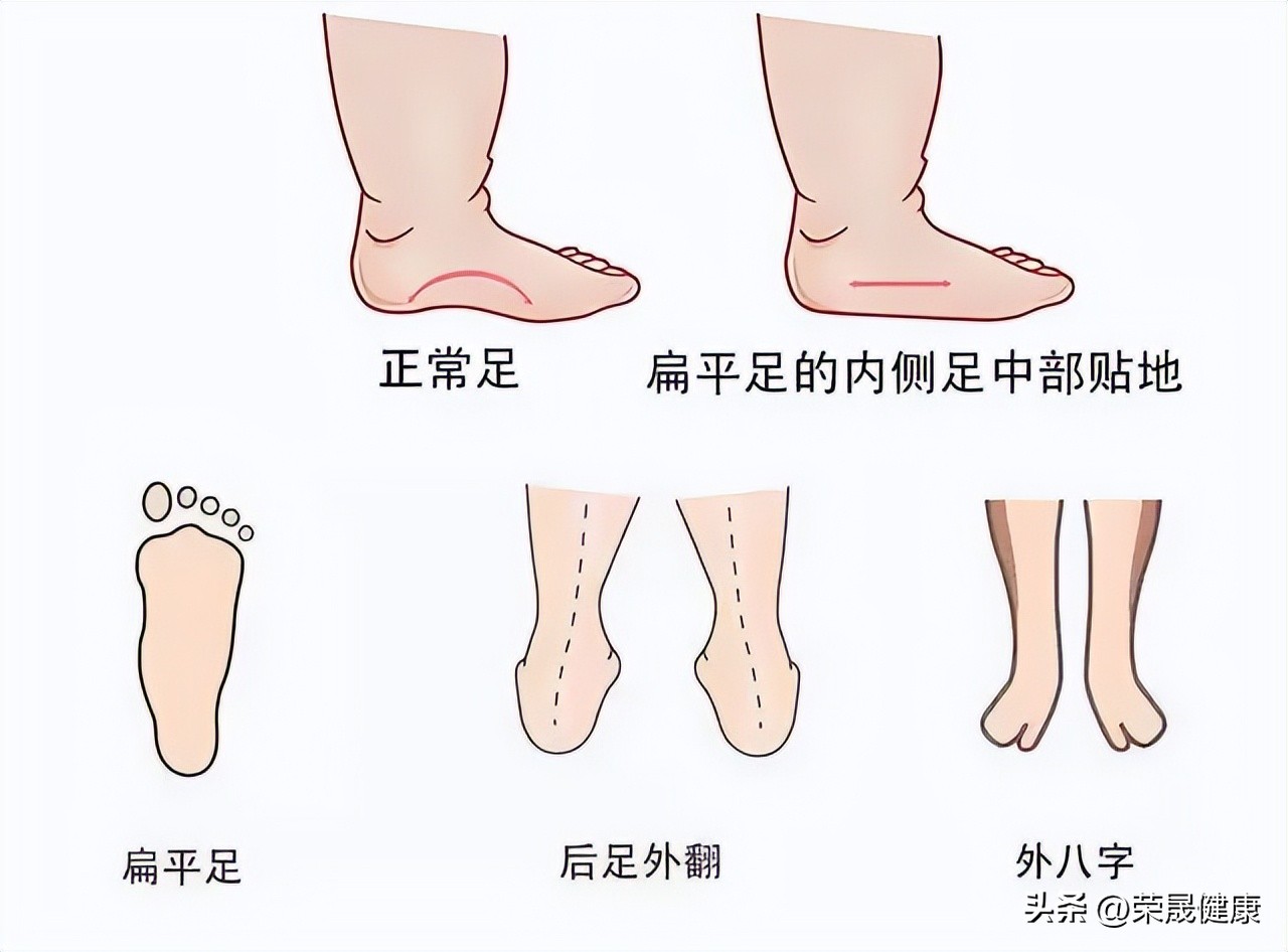 不想成为“唐老鸭”，这些在家就能做的平足练习一定要学起来！