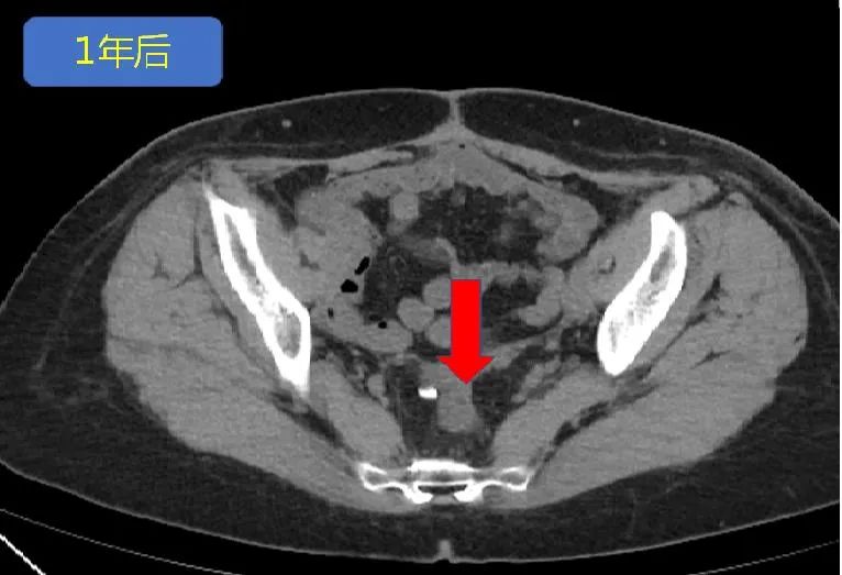 卵巢癌出现肠梗阻怎么治疗,卵巢癌晚期肠梗阻怎么治疗