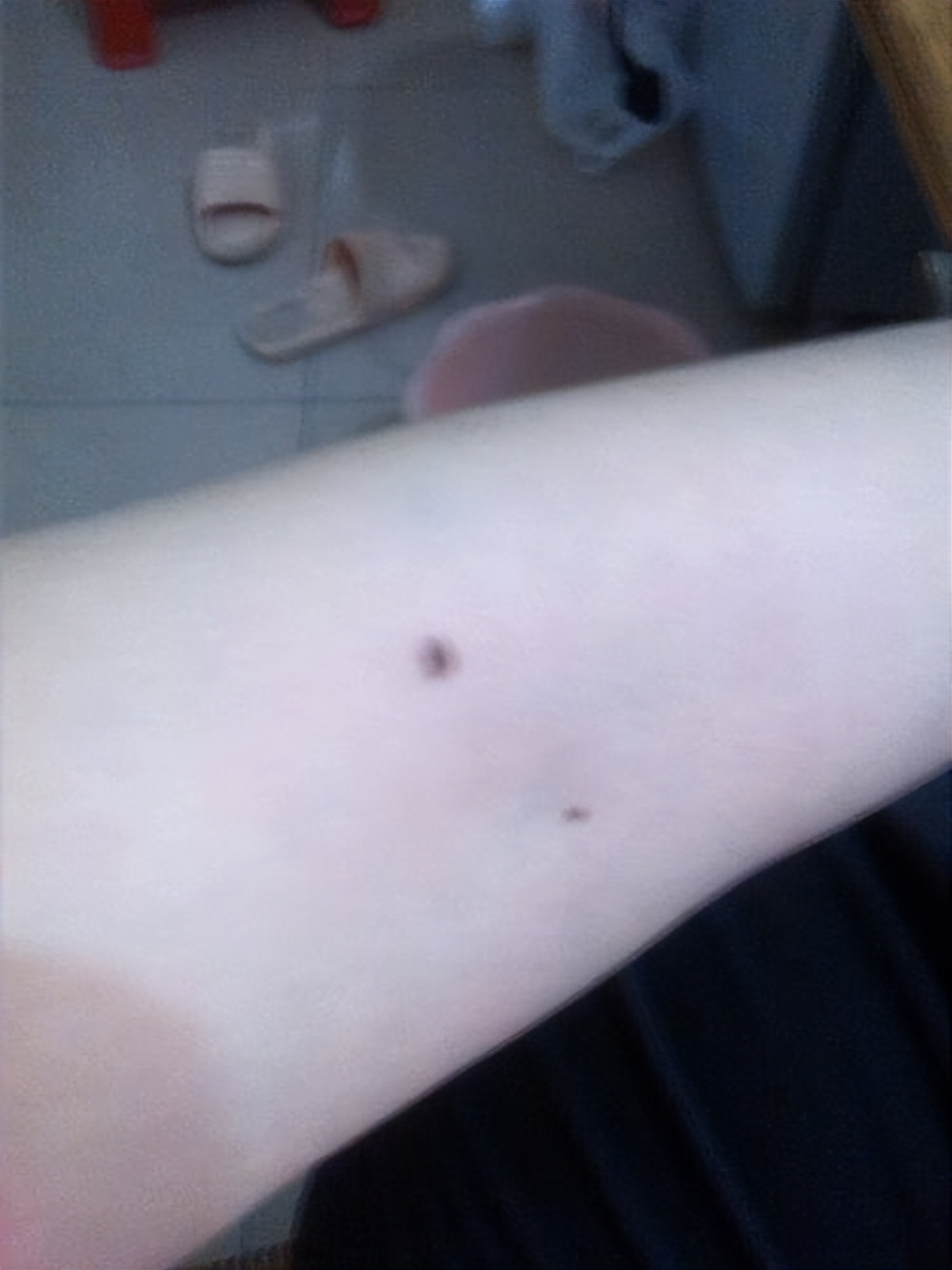 小孩痣长在什么地方代表什么,孩子身上的痣真的能预示未来