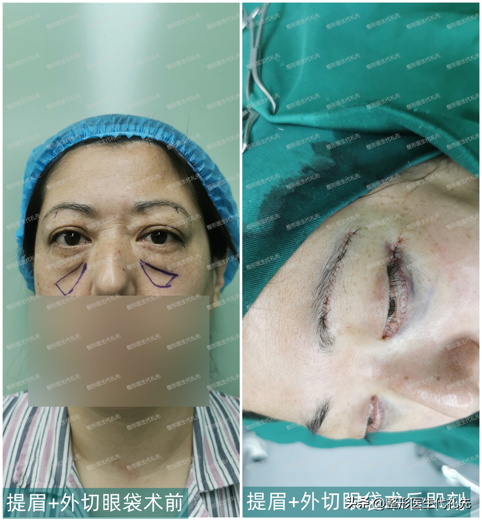 眼球鼓做全切双眼皮,全切双眼皮缝合位置有凸起小疙瘩