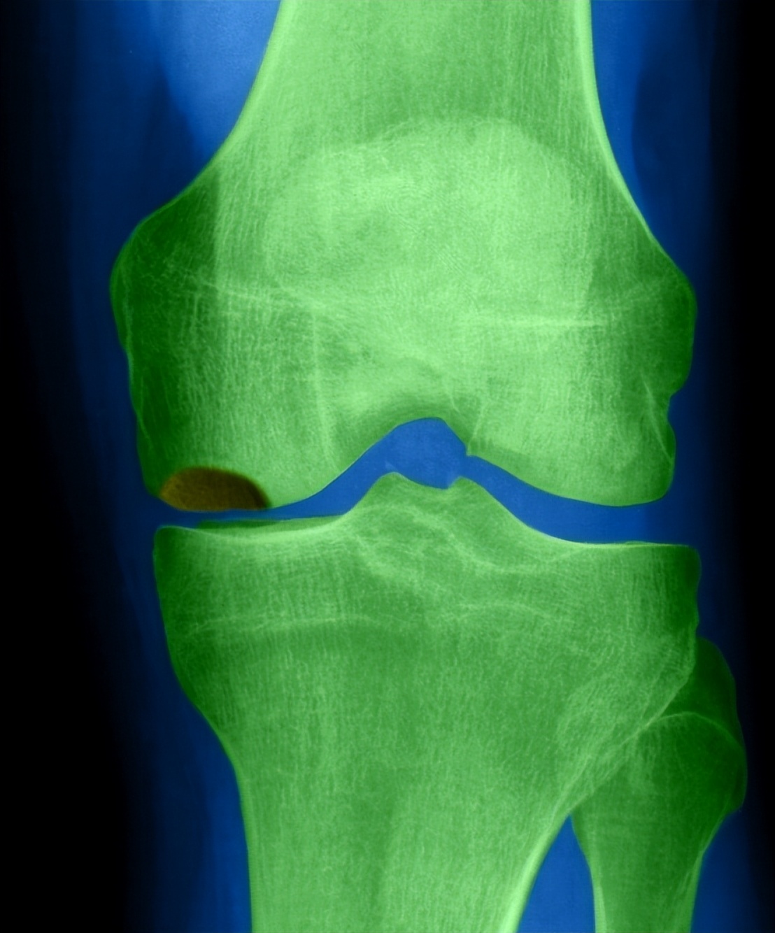 全球唯一可以治愈骨关节炎的药物,骨关节炎特效药最新研究