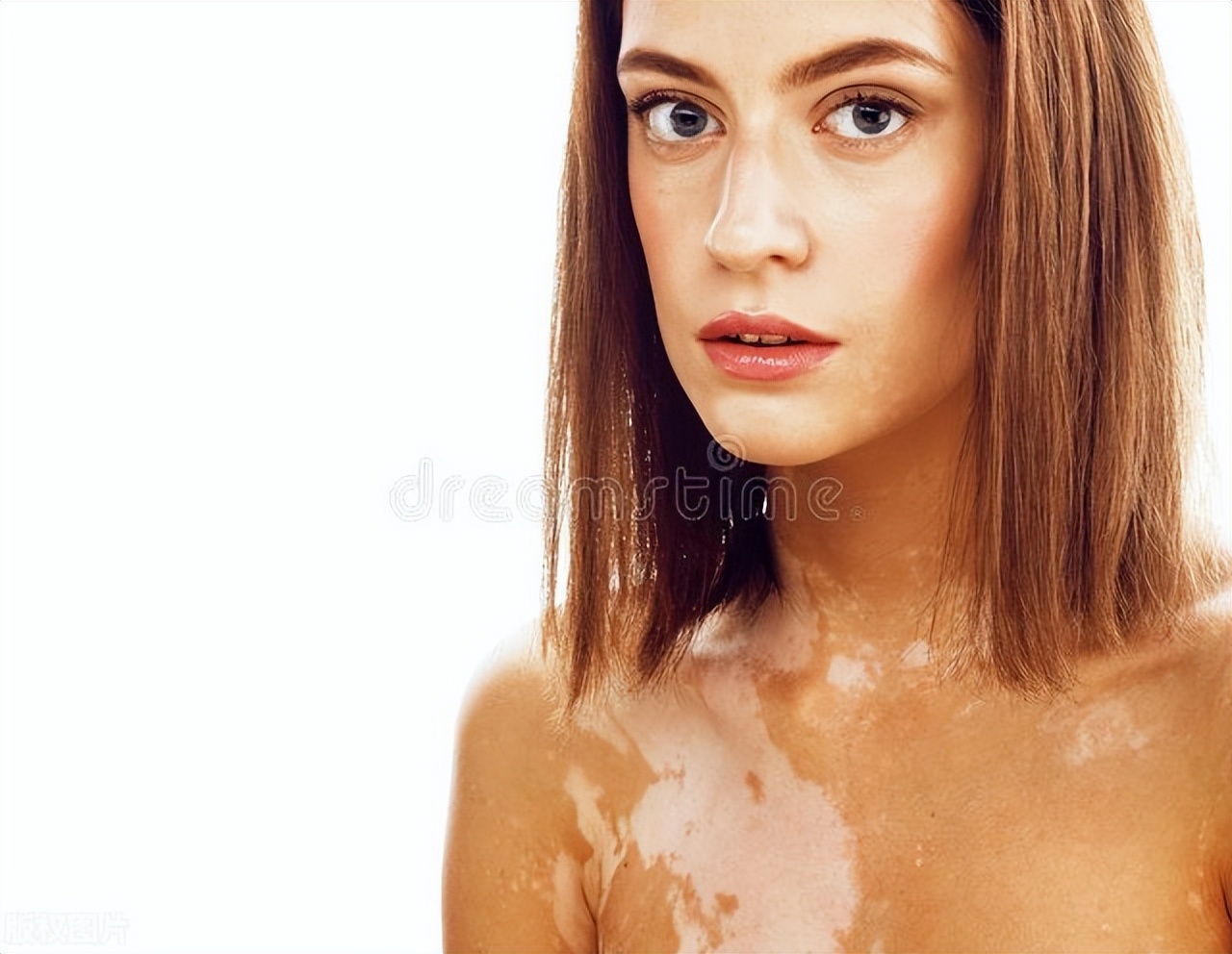 白癜风植皮后还会复发吗,白癜风不复发的方法