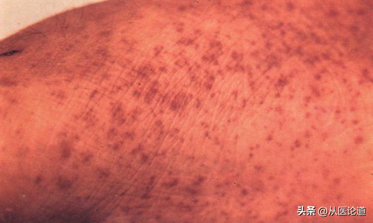 皮肤出现紫癜瘀点瘀斑,血小板减少性紫癜瘀斑