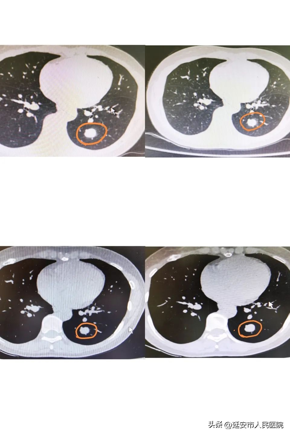 硬化性肺细胞瘤的治疗和预后,硬化性肺细胞瘤36例临床分析