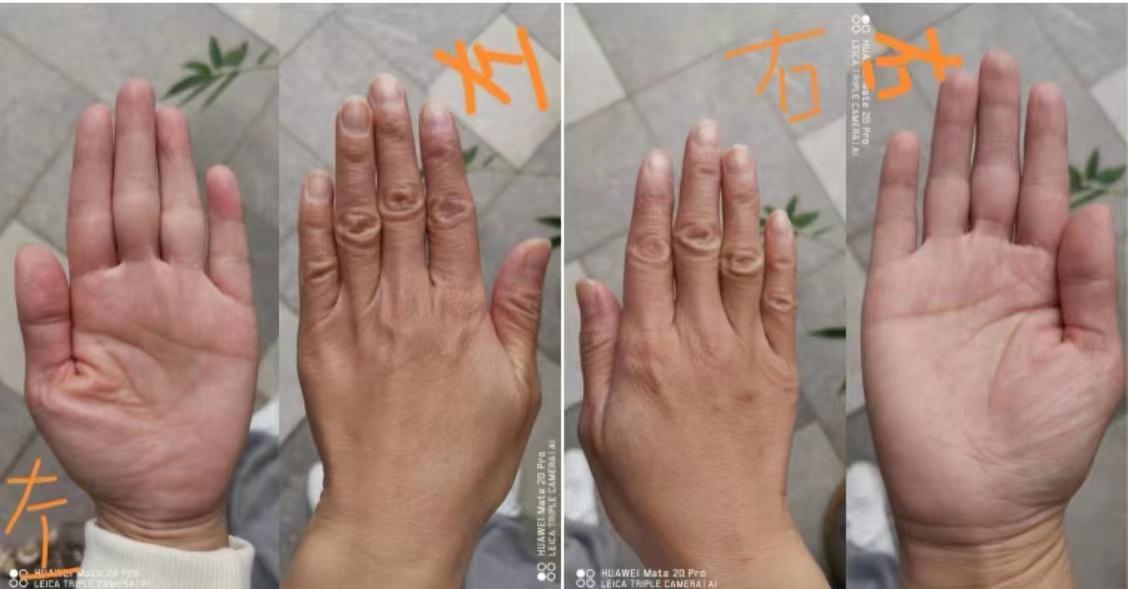 下焦不通手热是怎么回事,中焦不通会手脚心热吗