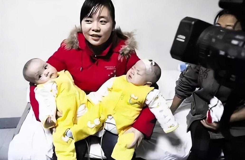 湖北女子生下连体婴儿,湖北孕妇生下首例“连体女婴”