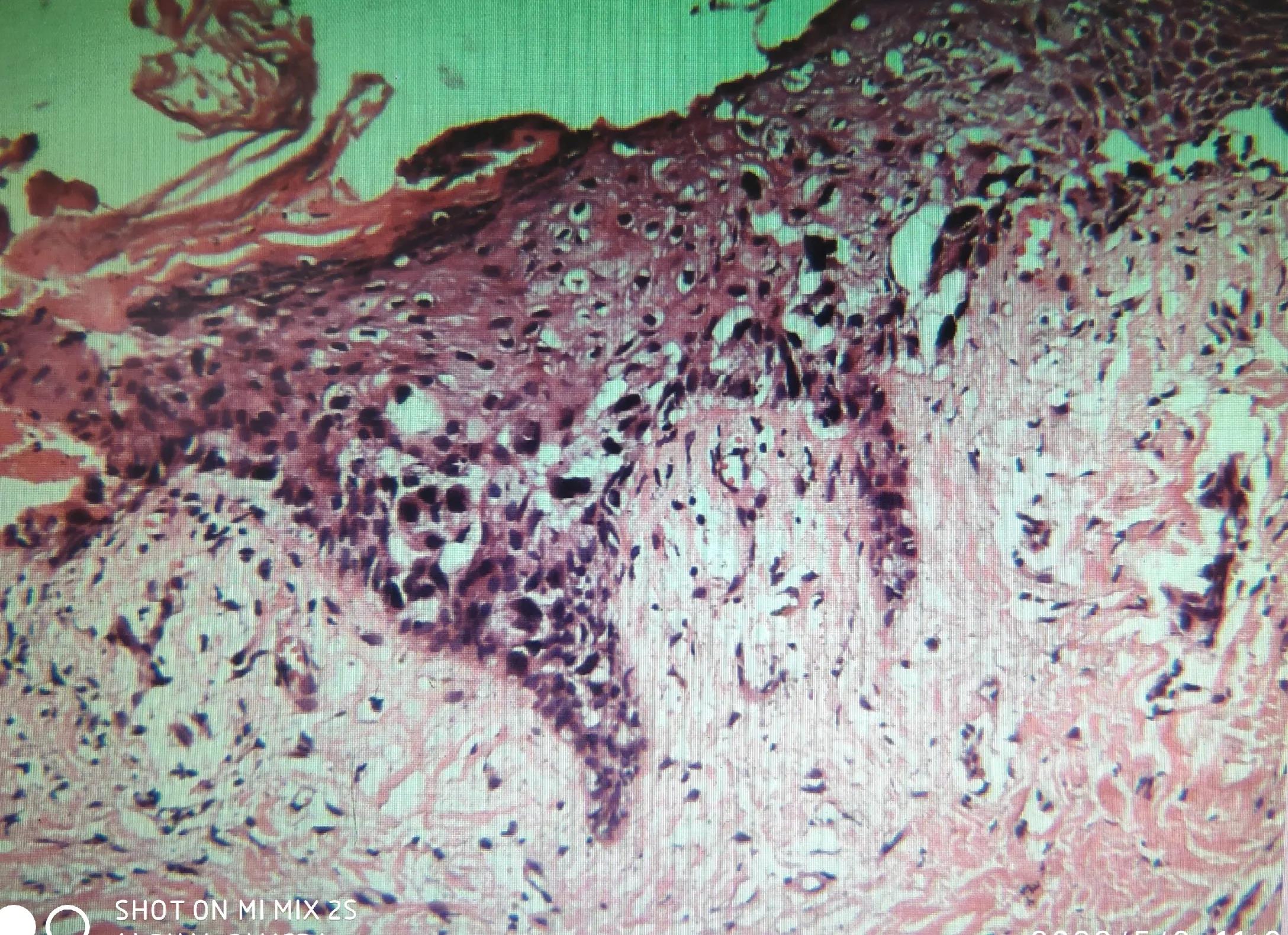 乳头湿疹样病变,乳头样湿疹