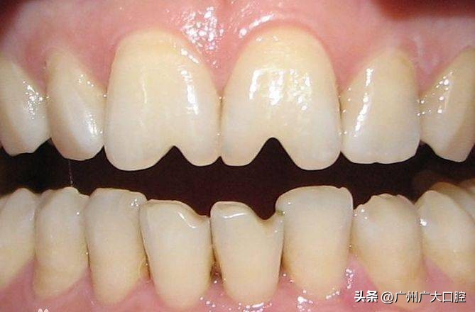 为什么小孩的牙齿像锯齿一样,为什么小孩的牙齿有裂纹