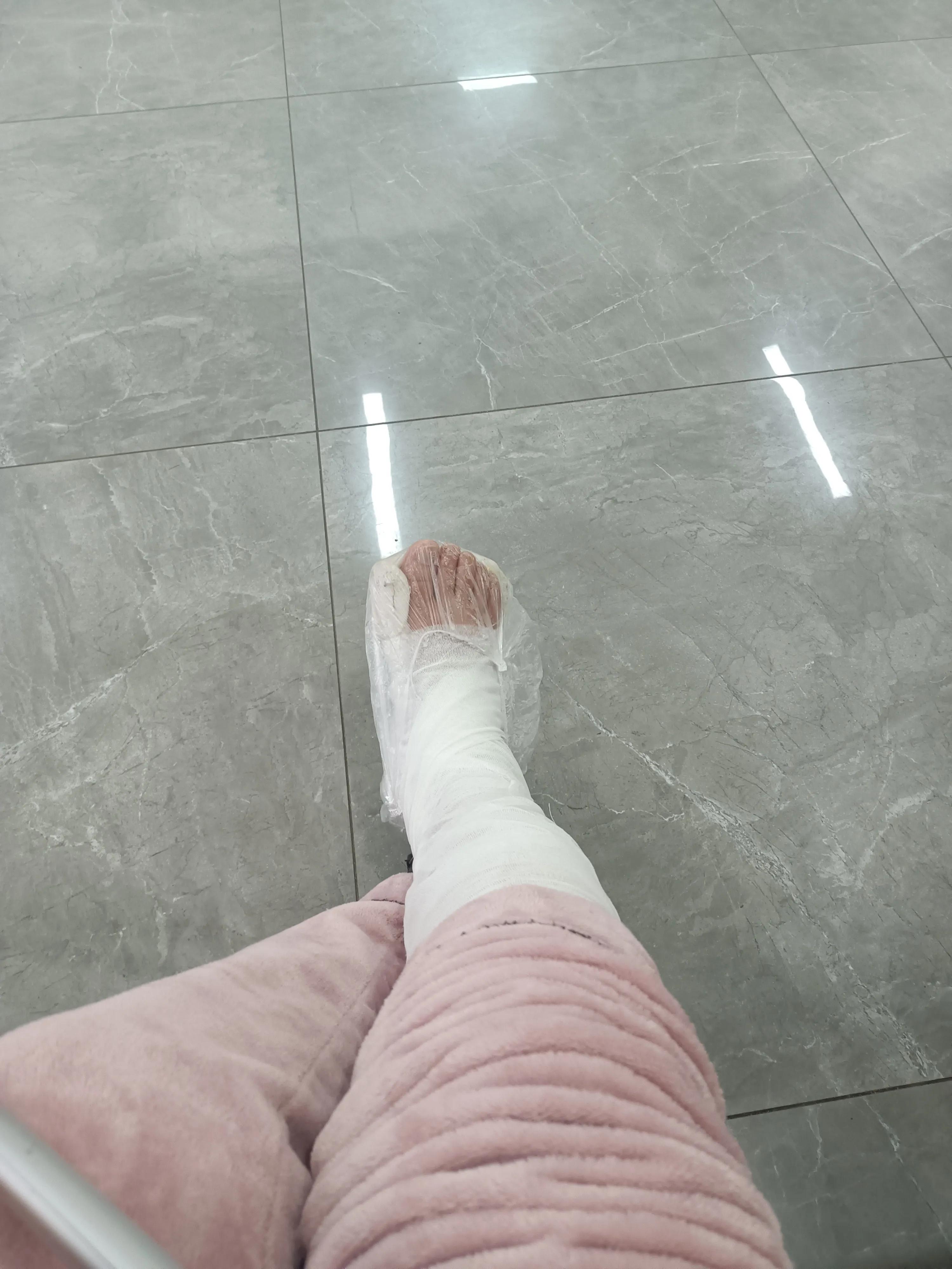 脚踝骨折一个月复查缝隙变大,左脚外踝撕脱骨折多久能恢复正常