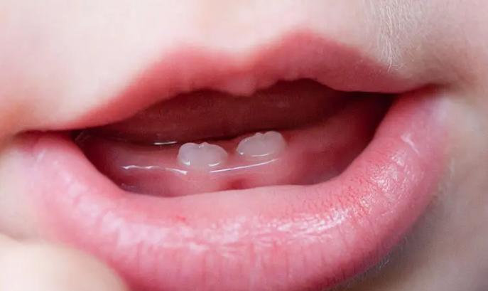 宝宝出牙晚缺钙怎么办,缺钙的孩子出牙晚吗