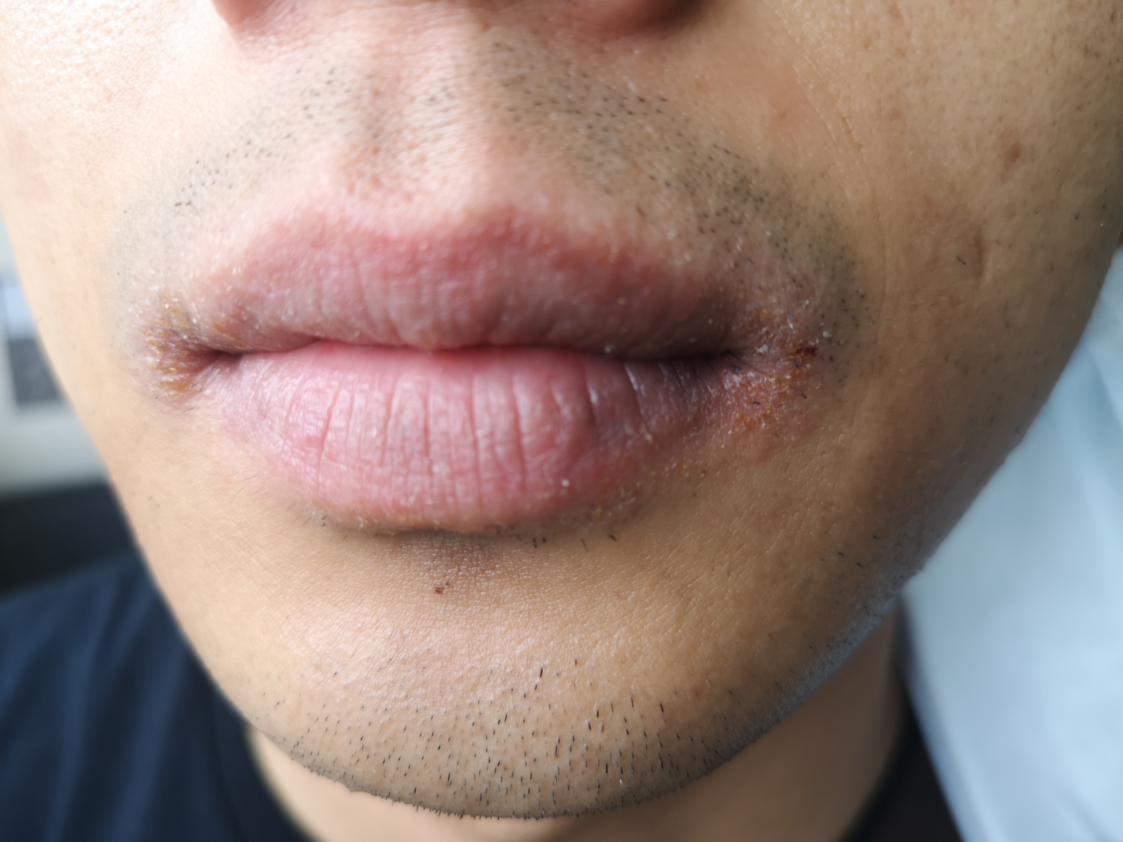 对镍过敏是怎么回事,镍过敏的人多不多